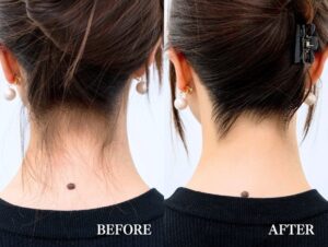 うなじ脱毛をするならここに注目！名古屋の脱毛サロンの選び方はこれ！