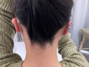 うなじ脱毛のメリット・デメリット！女性は、うなじ脱毛をする時にチェックするべきポイント！